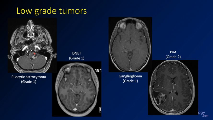 brain-tumors-topic-guide