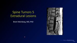 spine tumors 5