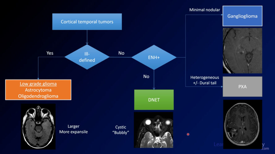 Neuroradiology Board Review - Brain Tumors - Case 16