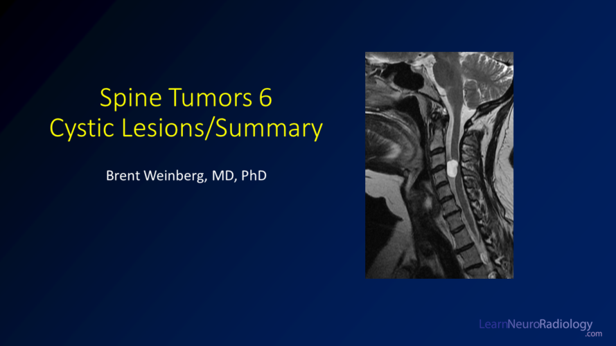 Spine Tumors - Topic Guide