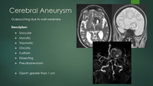 cerebral aneurysm video screenshot