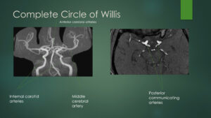 thumbnail from circle of willis video