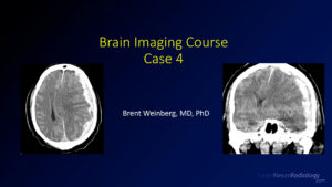 Brain imaging course case 4 thumbnail