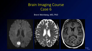 thumbnail for brain capstone case 6