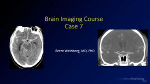 thumbnail for brain capstone case 7